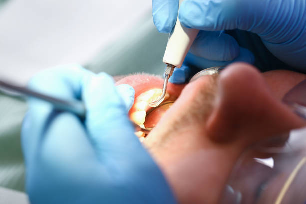 Best Emergency Treatment for Dental Infections or Abscesses in Highland, UT